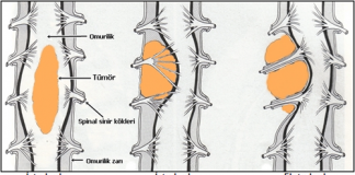 Omurilik Tümörleri